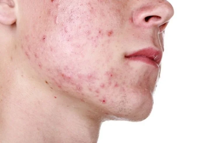 Acne and Scar Treatment