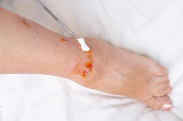 Non Healing Diabetic Wound