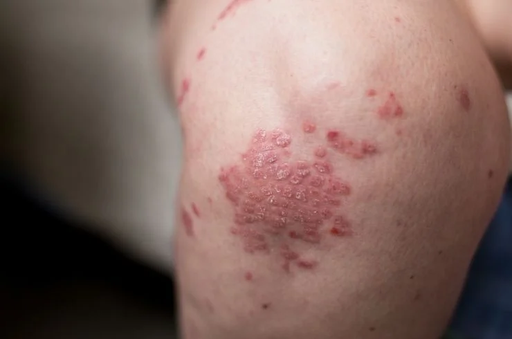 Psoriasis and Eczema Care